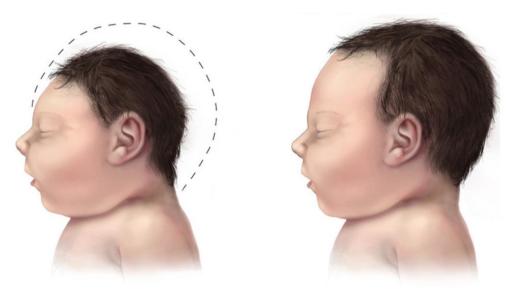 E protein of Zika virus affects normal properties of brain stem cells. Credit: Wikimedia Commons