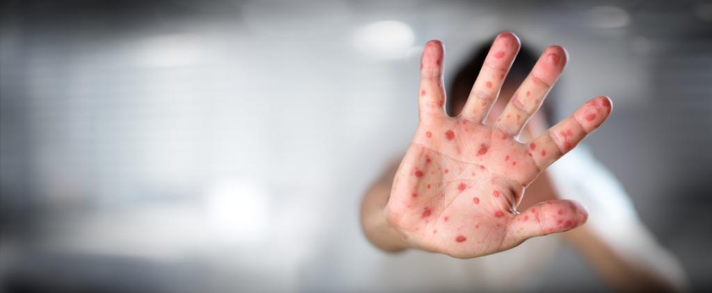 Measles. Photo: Getty Images Measles. Photo: Getty Images