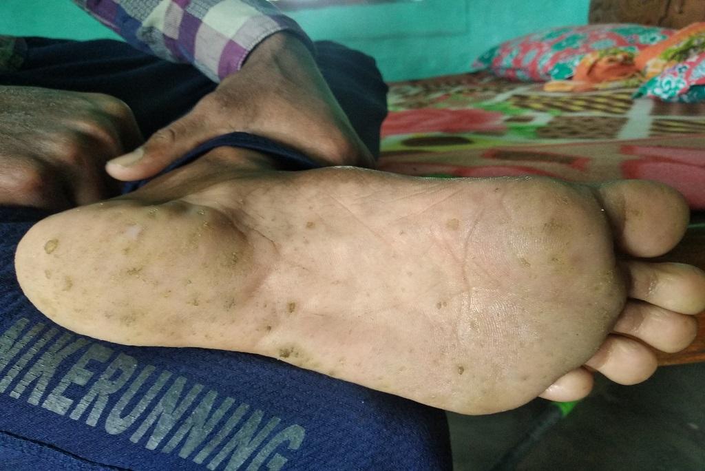 आर्सेनिक की वजह से बिहार में इस तरह के रोग बढ़ रहे हैं। फोटो: उमेश कुमार राय आर्सेनिक की वजह से बिहार में इस तरह के रोग बढ़ रहे हैं। फोटो: उमेश कुमार राय