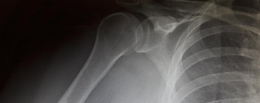 This new protein may help diabetes patients with fractures thumbnail