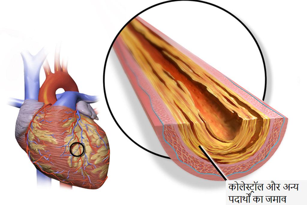 What is heart attack How can you avoid it? What is heart attack How can you avoid it?